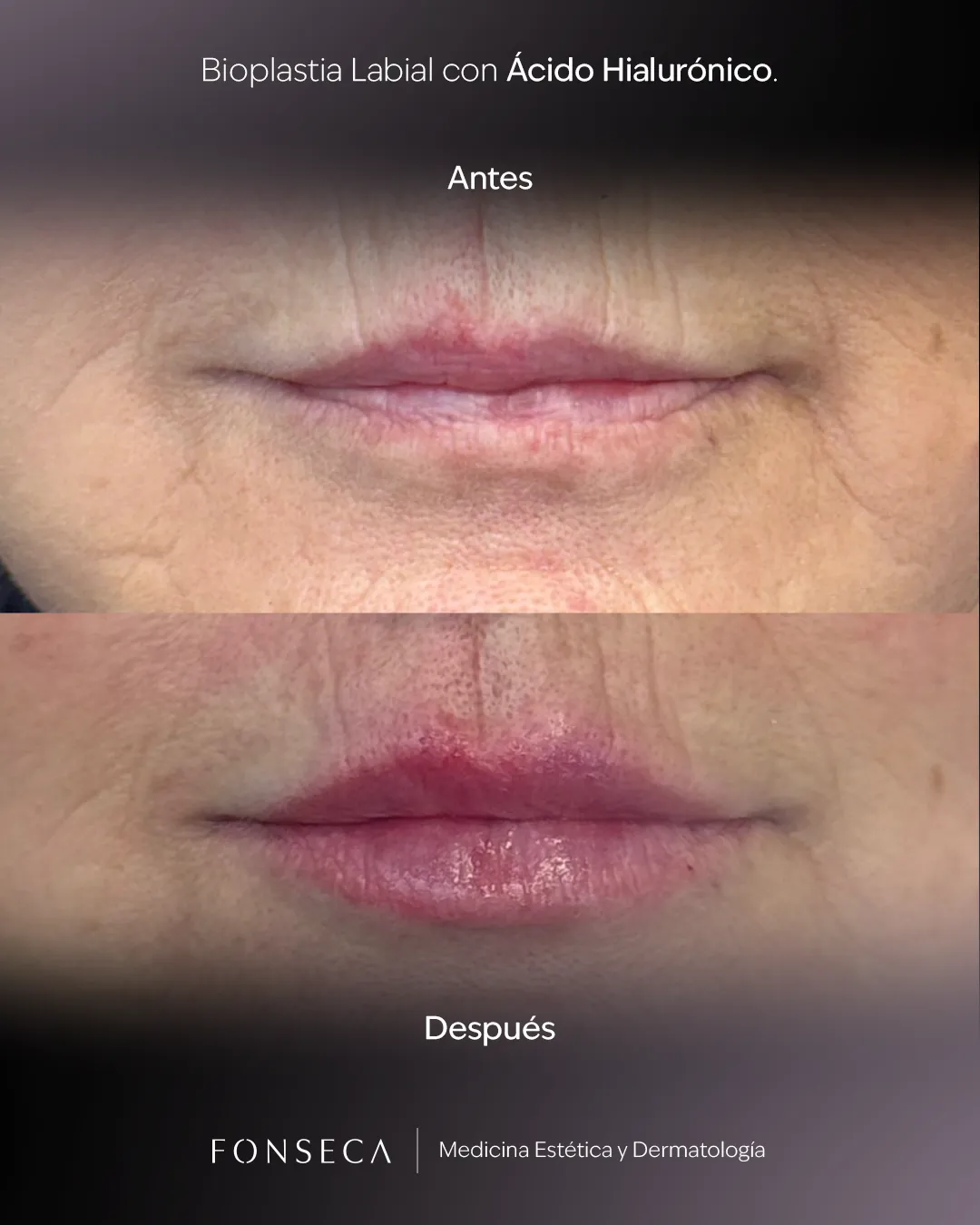 Bioplastia-Labial-Muro-01