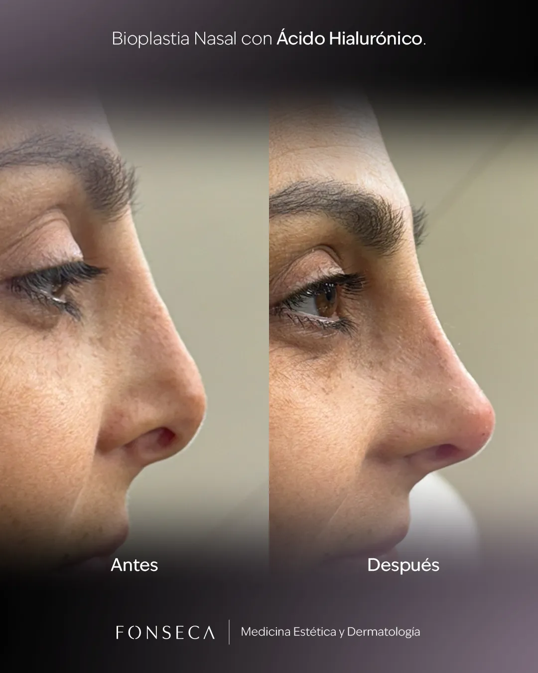 Bioplastia-Nasal-Muro-03