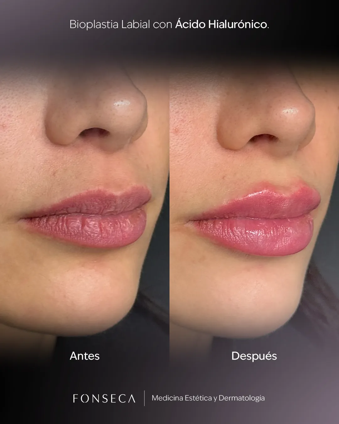 Copia de Bioplastia-Labial-Muro-01