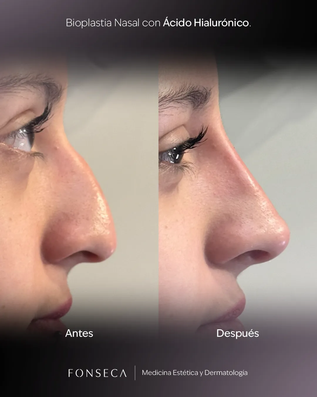 Copia de Bioplastia-Nasal-Muro-01